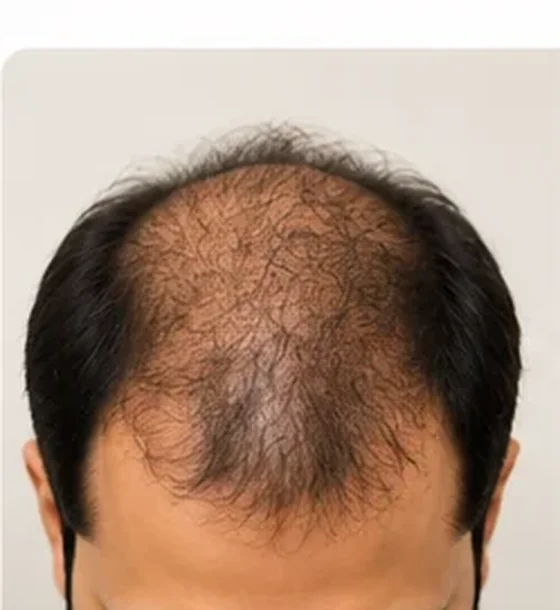 Before - man with thinning hair