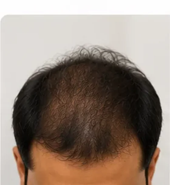 Before - man with visible scalp and thin hair